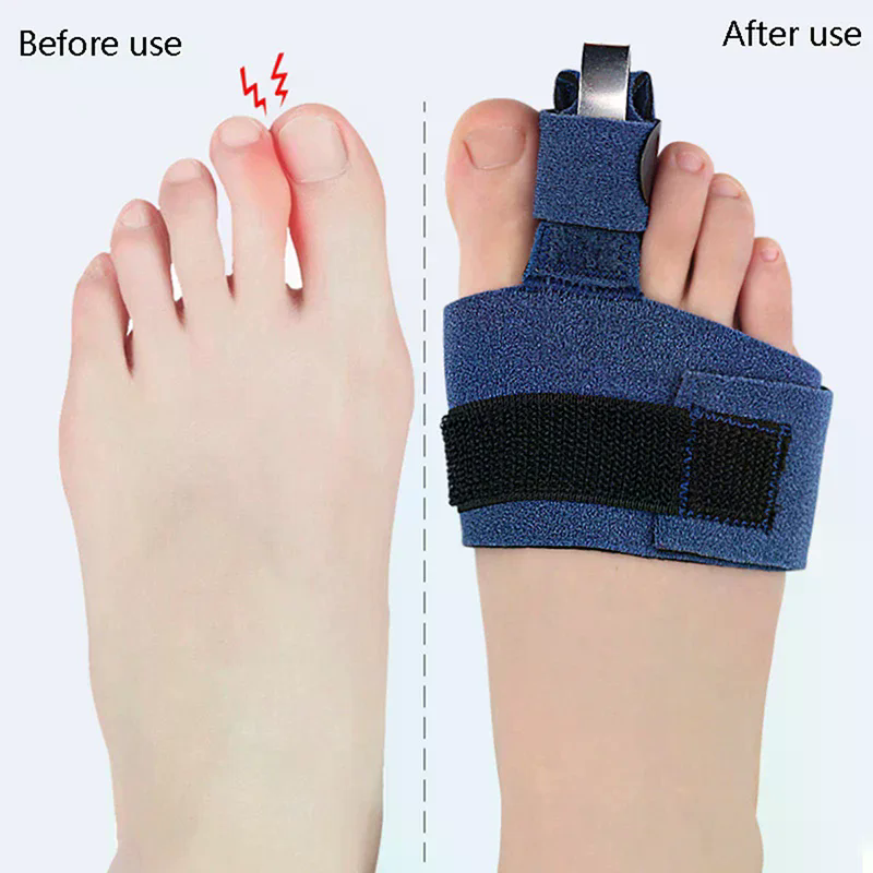 1Pcs Toe Corrector Toe Fractur - Ankle Brace Sock recensione e prezzo